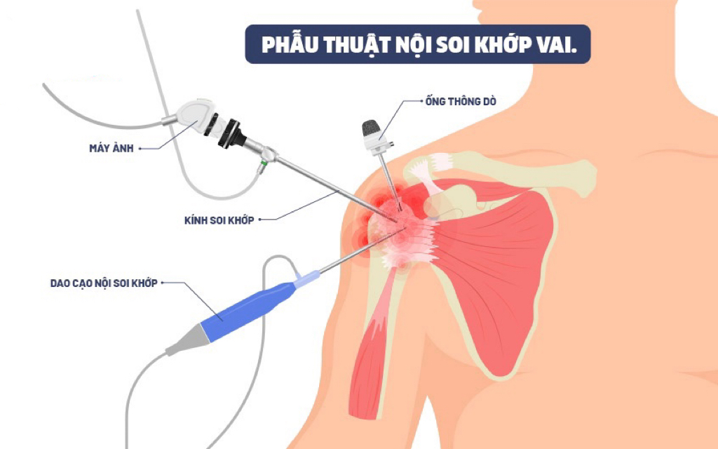 Nội soi khớp vai
